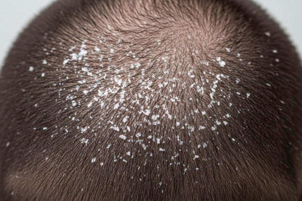 How Do I Get Rid of Dry Flaky Hair Naturally.Proven Home Remedies for Men